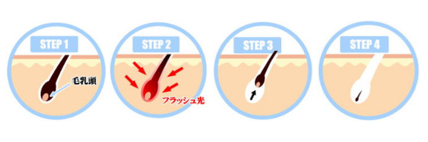 光脱毛のメカニズムの画像です