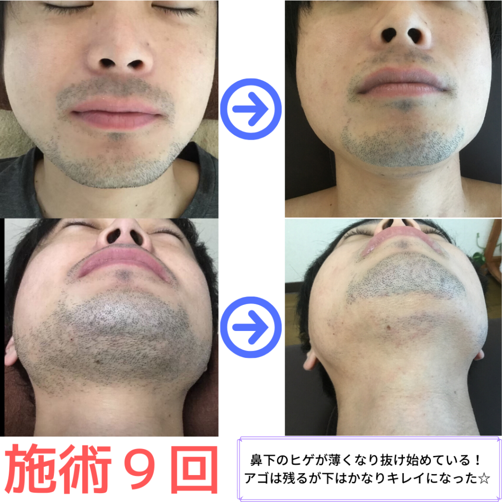 ヒゲ脱毛９回のビフォーアフター写真です