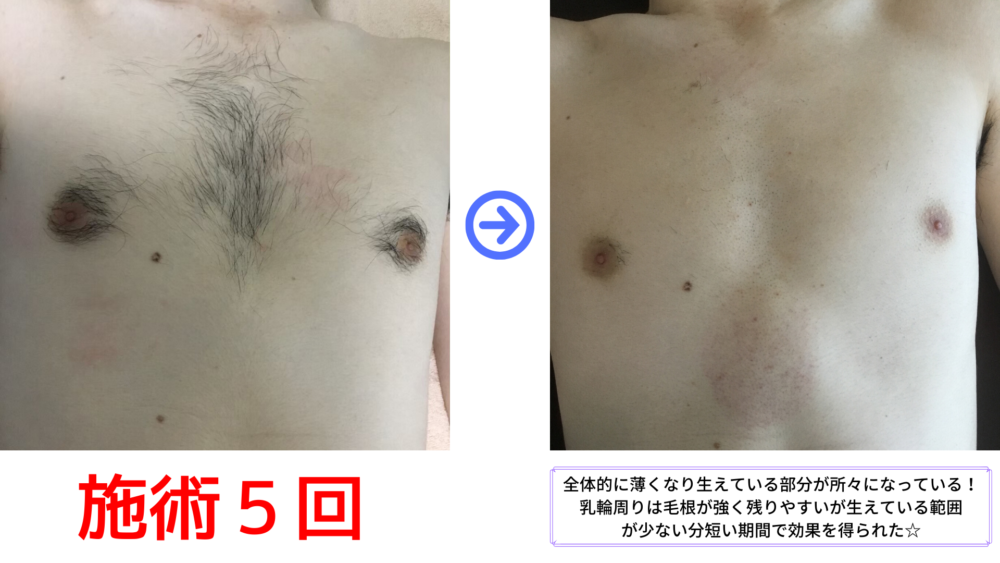胸脱毛５回のビフォーアフター写真です