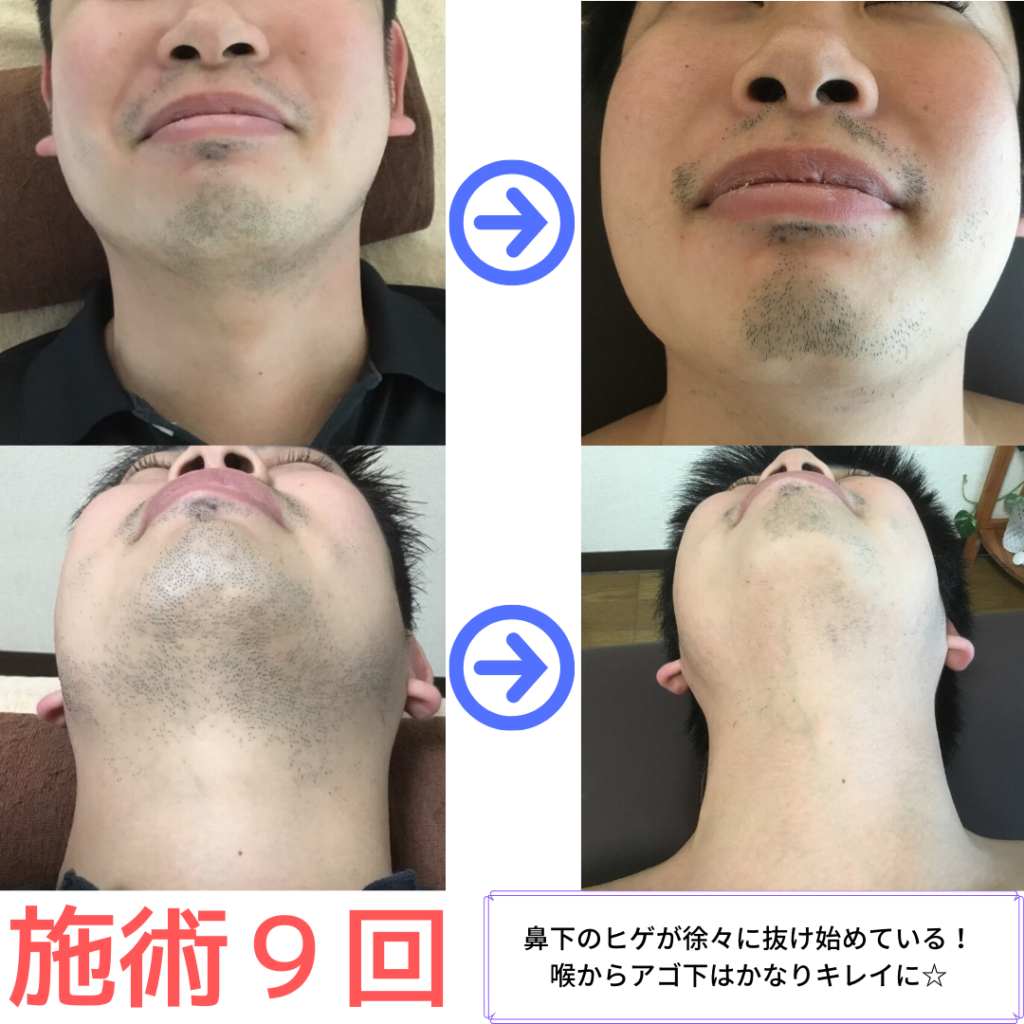 ヒゲ脱毛９回のビフォーアフター写真です
