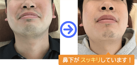 鼻下のヒゲが少し薄くなっています！