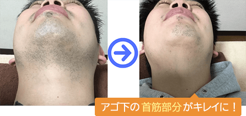 アゴ下は全体的に毛量が少なくなっています