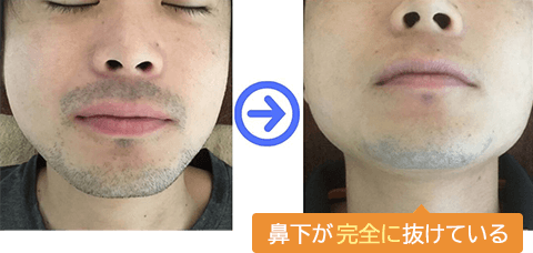鼻下の両サイドが薄くなっています