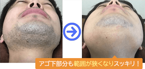 アゴ下の所々が抜けて、髭剃りの時間が極端に短縮！