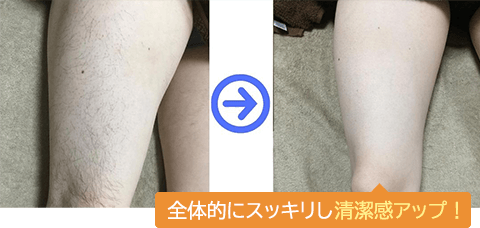 鼻下の両サイドが薄くなっています