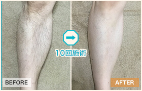 10回施術のビフォーアフター
