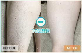10回施術のビフォーアフター