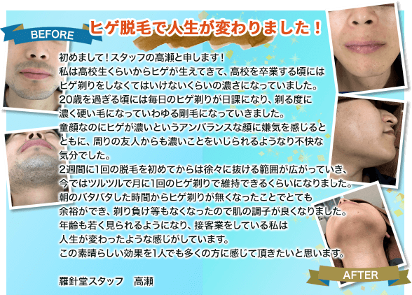 【ヒゲ脱毛で人生が変わりました!】初めまして!スタッフの高瀬と申します!私は高校生くらいからヒゲが生えてきて、高校を卒業する頃にはヒゲ剃りをしなくてはいけないくらいの濃さになっていました。20歳を過ぎる頃には毎日のヒゲ剃りが日課になり、剃る度に濃く硬い毛になっていわゆる剛毛になっていきました。童顔なのにヒゲが濃いというアンバランスな顔に嫌気を感じるとともに、周りの友人からも濃いことをいじられるようなり不快な気分でした。2週間に1回の脱毛を初めてからは徐々に抜ける範囲が広がっていき、今ではツルツルで月に1回のヒゲ剃りで維持できるくらいになりました。朝のバタバタした時間からヒゲ剃りが無くなったことでとても余裕ができ、剃り負け等もなくなったので肌の調子が良くなりました。年齢も若く見られるようになり、接客業をしている私は人生が変わったような感じがしています。この素晴らしい効果を1人でも多くの方に感じて頂きたいと思います。