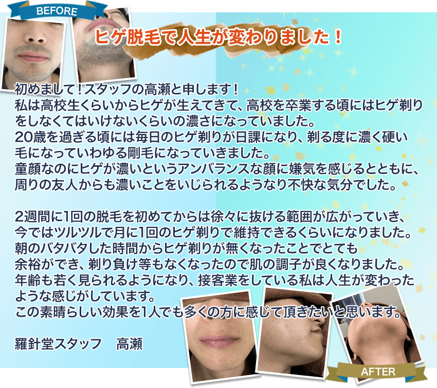 【ヒゲ脱毛で人生が変わりました!】初めまして!スタッフの高瀬と申します!私は高校生くらいからヒゲが生えてきて、高校を卒業する頃にはヒゲ剃りをしなくてはいけないくらいの濃さになっていました。20歳を過ぎる頃には毎日のヒゲ剃りが日課になり、剃る度に濃く硬い毛になっていわゆる剛毛になっていきました。童顔なのにヒゲが濃いというアンバランスな顔に嫌気を感じるとともに、周りの友人からも濃いことをいじられるようなり不快な気分でした。2週間に1回の脱毛を初めてからは徐々に抜ける範囲が広がっていき、今ではツルツルで月に1回のヒゲ剃りで維持できるくらいになりました。朝のバタバタした時間からヒゲ剃りが無くなったことでとても余裕ができ、剃り負け等もなくなったので肌の調子が良くなりました。年齢も若く見られるようになり、接客業をしている私は人生が変わったような感じがしています。この素晴らしい効果を1人でも多くの方に感じて頂きたいと思います。