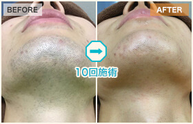 10回施術のビフォーアフター