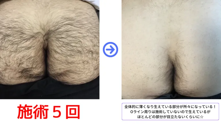 大和市在住30代 お尻脱毛