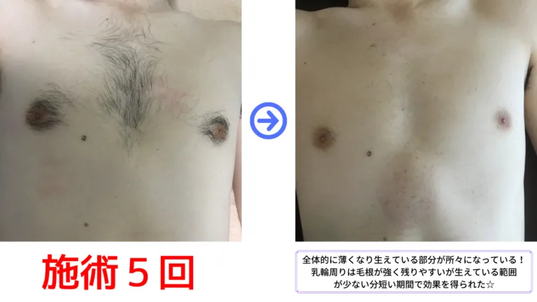 大和市在住40代 胸脱毛