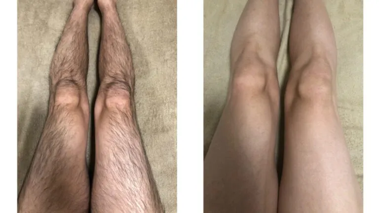 大和市在住 30代 脚脱毛