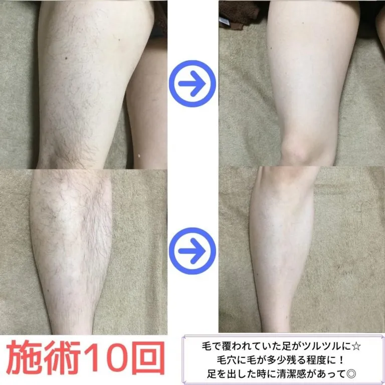 大和市在住40代 足脱毛