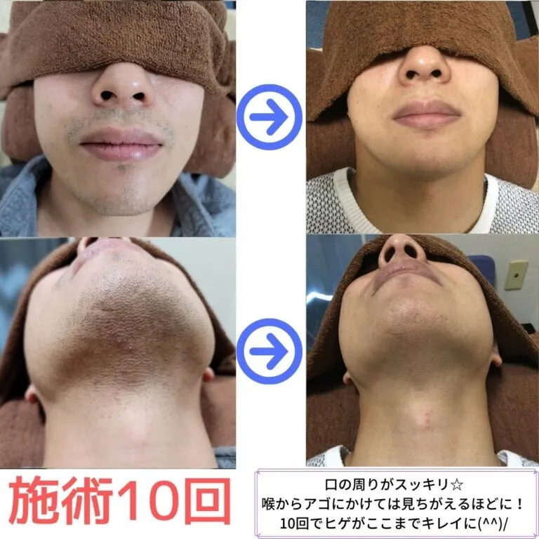 大和市在住30代 ひげ脱毛