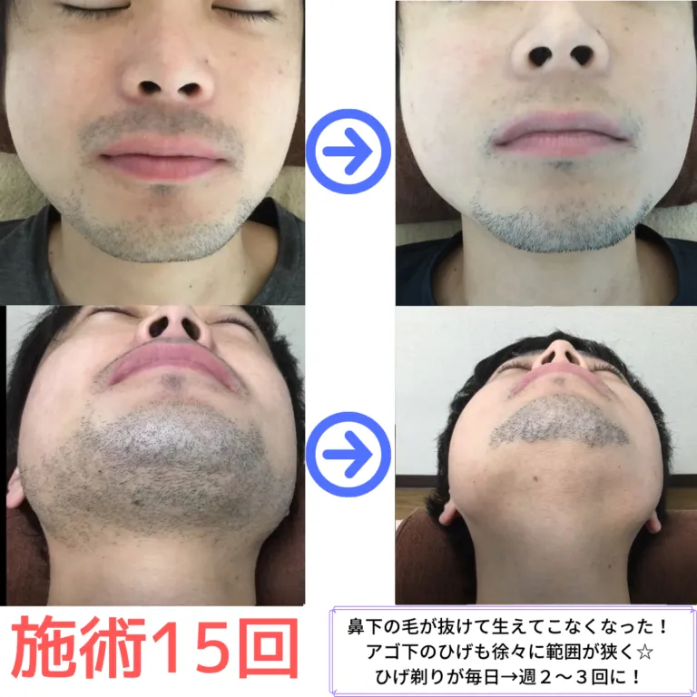 大和市在住30代(スタッフ) ひげ脱毛