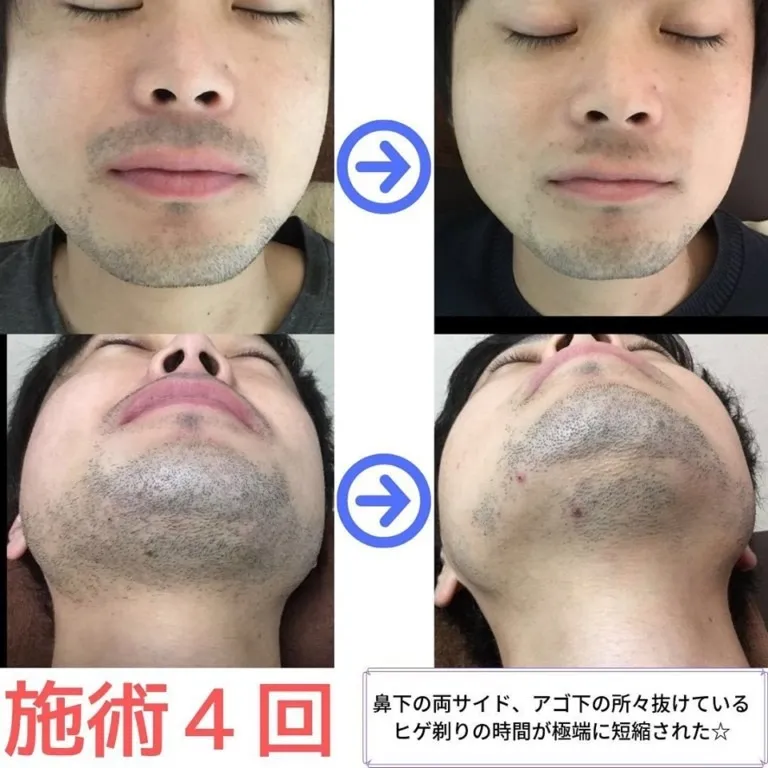 大和市在住30代(スタッフ) ひげ脱毛