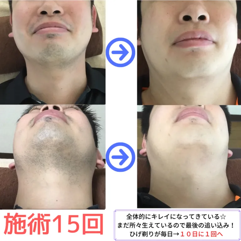 大和市在住30代(スタッフ) ひげ脱毛