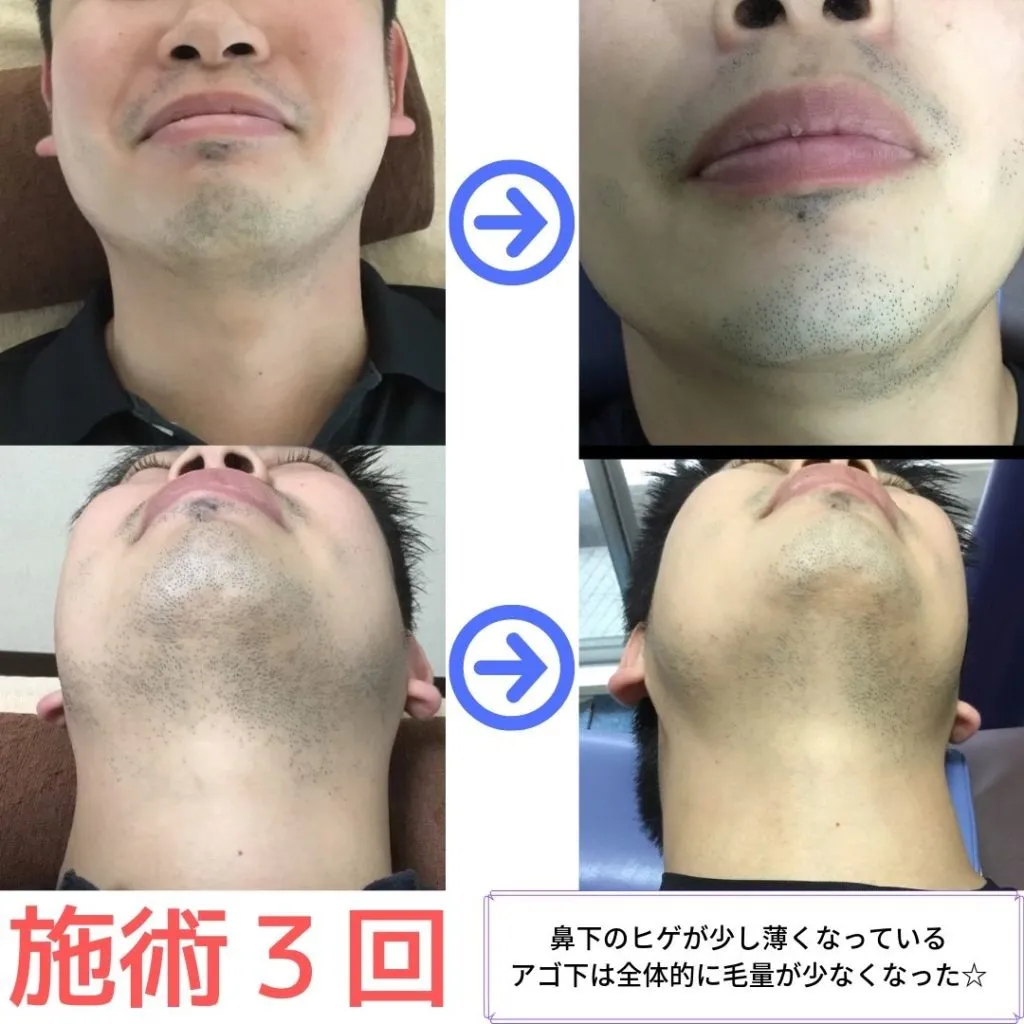 大和市在住30代(スタッフ) ひげ脱毛