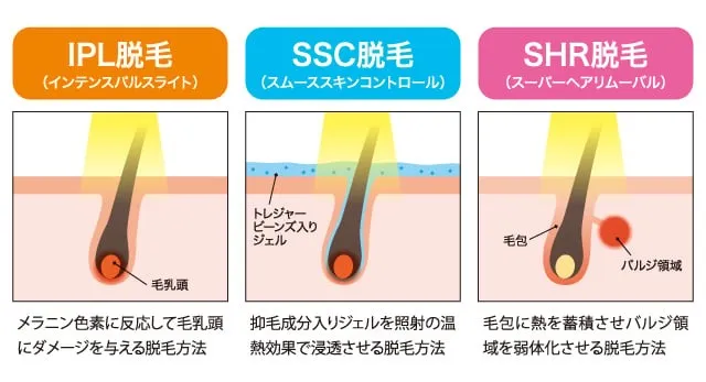 【大和脱毛の知って得する情報】光脱毛の種類を理解しよう！