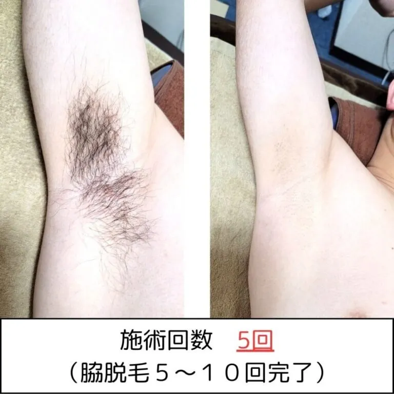 メンズの脇脱毛で清潔感アップ！第一印象を変えるなら今【RASHINDO大和店】