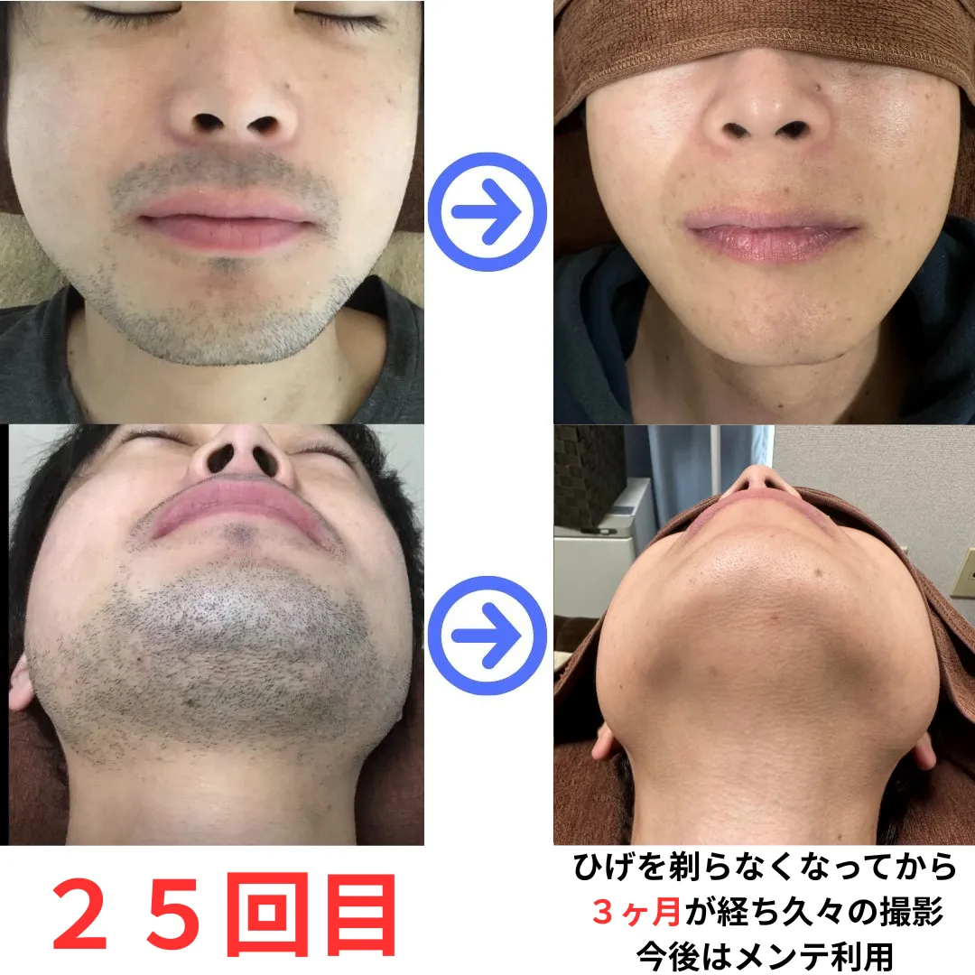 大和市在住30代(スタッフ) ひげ脱毛