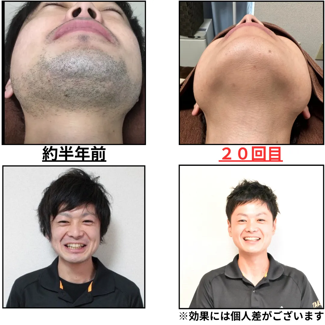 大和市在住30代 ひげ脱毛