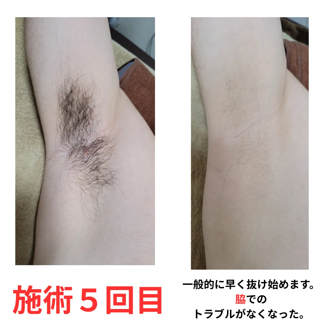 大和市在住20代 脇脱毛