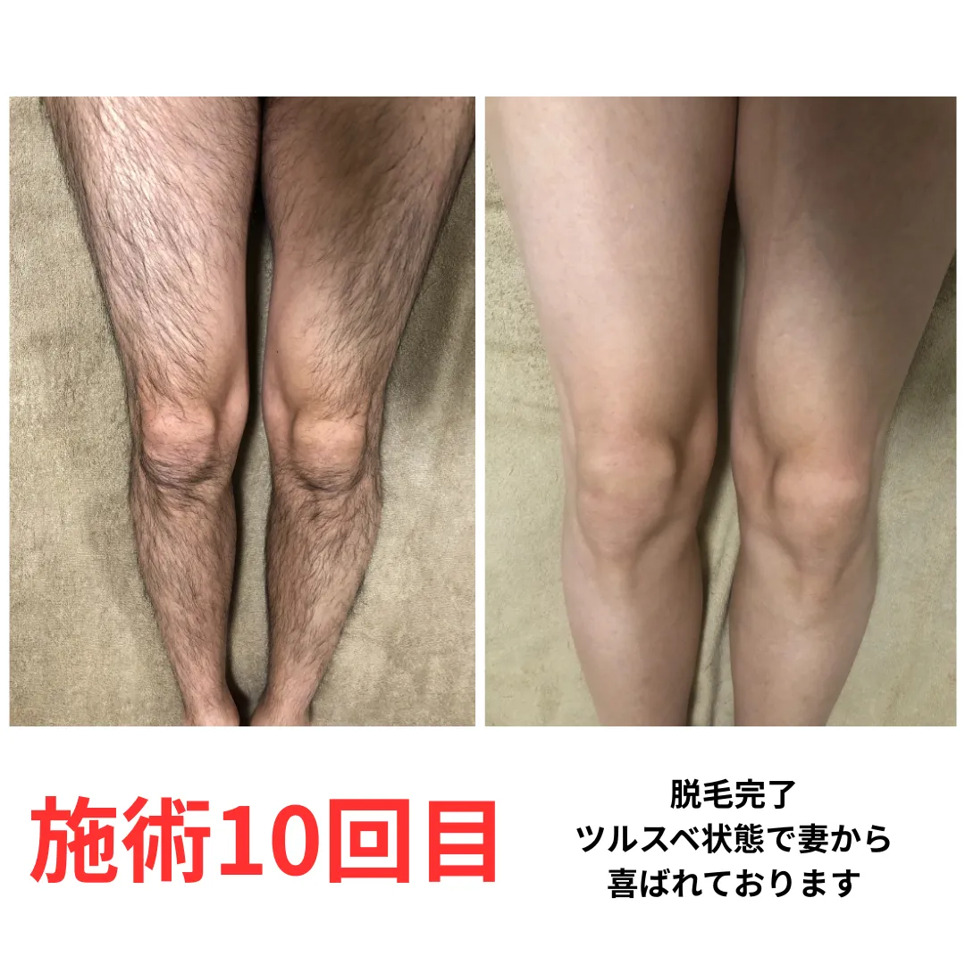 大和市在住 30代 脚脱毛