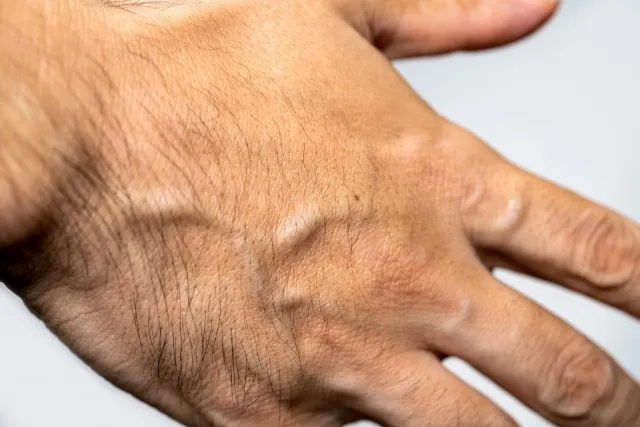 脱毛で手元美人に神奈川県大和市で理想を叶える方法