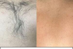 メンズの背中脱毛で後ろ姿に自信を！見えないところまで整える大人の身だしなみ【RASHINDO大和店】